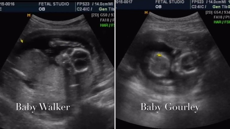 double baby gender reveal